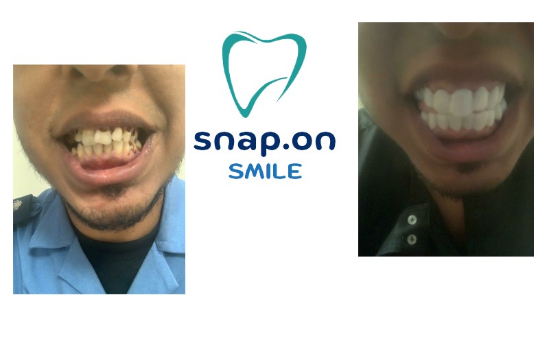 ٍSnap on Smile